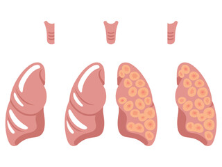 Medical Diagram of Lung Cancer Stages Showing Healthy and Cancerous Lungs, Oncology Illustration