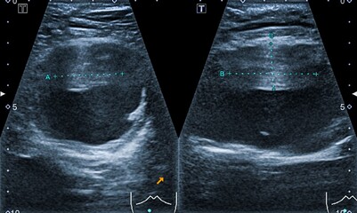 Ultrasound scan of a patient's abdominal aorta aneurysm 
