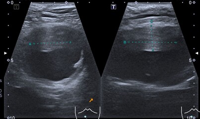 Ultrasound scan of a patient's abdominal aorta aneurysm 
