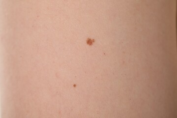 Fototapeta premium Woman with moles on her body, closeup