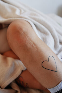 Close-up of a knee scar on human skin