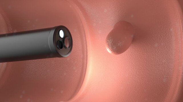Medical technology with 3d rendering endoscope and colonic polyp in intestine 4k footage