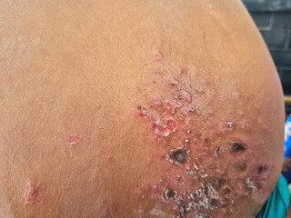 Fototapeta premium Close up image of skin texture suffering severe urticaria or hives or kaligata in shoulder asian girl. Allergy symptoms, with wounds that partially dry out from eating seafood.