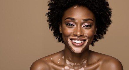 Smiling woman with vitiligo on neutral backdrop. Beauty portrait, soft light. Skin positivity and dermatology concept. Cosmetics, makeup services, awareness campaigns, healthcare branding