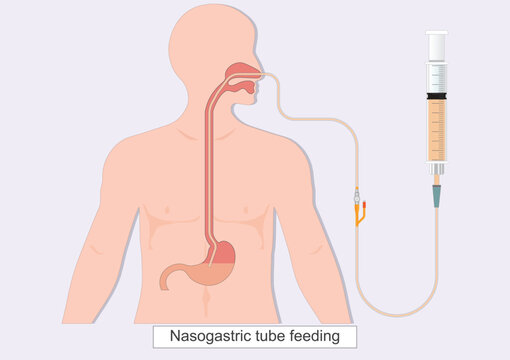 Nasogastric tube feeding (NG) is a thin flexible tube