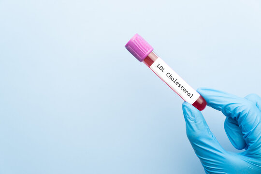 Blood sample tube with LDL cholesterol test label on medical laboratory technologist hands over blue background.