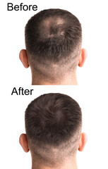 Obraz premium Man before and after hair treatment on white background, collage. Back view