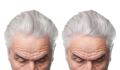 Man before and after hair treatment on white background, collage
