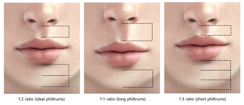 types of philtrums