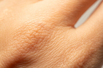 Macro close-up of dry human skin texture on the back of a hand, showing fine lines and patterns