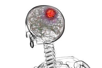 Brain tumor, 3D illustration