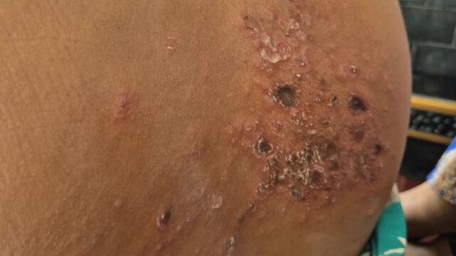 Close up image of skin texture suffering severe urticaria or hives or kaligata in shoulder asian girl. Allergy symptoms, with wounds that partially dry out from eating seafood.
