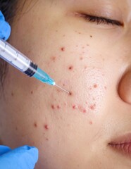 Close-up of acne treatment injection on a young woman's face