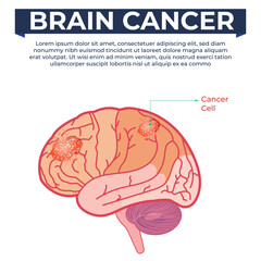 Understanding Brain Cancer Diagnosis and Survival Rates