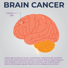 Early Signs of Brain Cancer and How to Prevent It