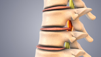 Spinal Decompression Therapy Explained in Medical Animation