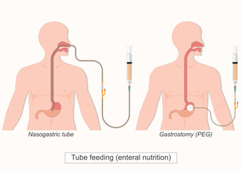 Tube feeding (enteral nutrition).