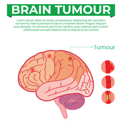 Understanding Brain Tumour Types Risks and Recovery