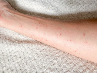 Allergic reaction on the hands.Red spots on the hand.