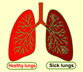 Vector medical illustration of human lungs, Comparison Illustration of Healthy and Sick Lungs
