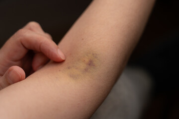 In the elbow bend, in the cubital fossa, there is a large bruise of blue and yellow hues formed after an injection