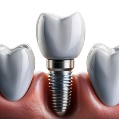 tooth implant isolated on white background