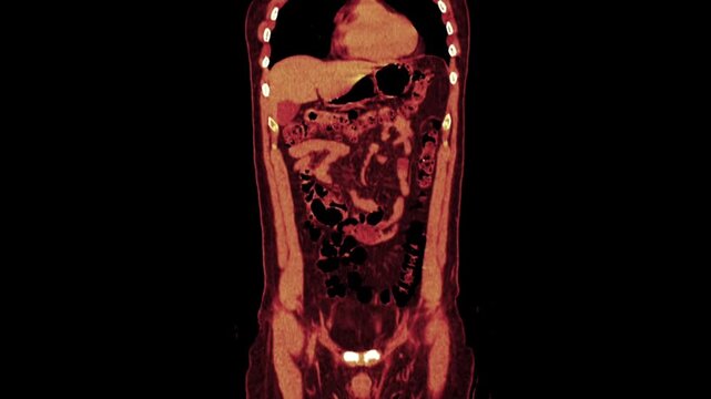 abdomen CT scan 3d rendering showing kidney stone and Dj stent JJ stent (down left) in a urinary system. The stent has been inserted in the patient's ureter to keep it open
