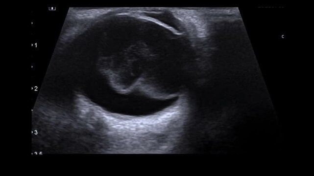 Globe rupture, orbita traumatic, USG ,ultrasound image 
