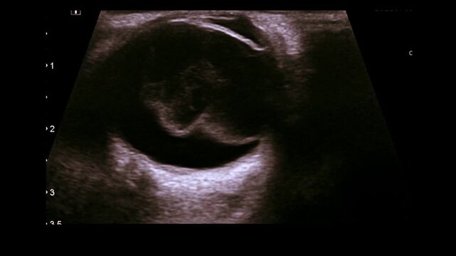 Globe rupture, orbita traumatic, USG ,ultrasound image 
