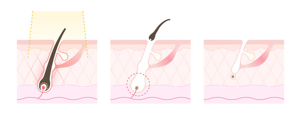 脱毛のイメージ、美容脱毛・光脱毛のしくみのイラスト