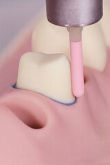 Tooth preparation with pink abrasive polishing tool on dental model, close-up of crown margin finishing, dental handpiece in restorative dentistry training, simulated gum and tooth anatomy
