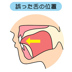 正しいミューイングの方法　適正な舌の位置と誤った舌の位置 © koti
