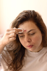 Close-up of a young woman with acne gently wiping her face with a cotton pad soaked in toner. Emphasizes skincare routine, acne treatment, and home facial care.