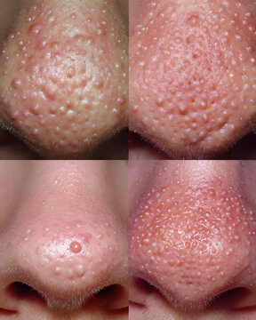 Pilosebaceous units
