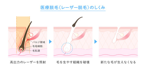 脱毛のイメージ、医療脱毛・レーザー脱毛のしくみ