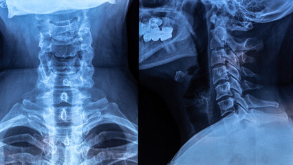 X-ray with cervical lordosis. P-signs of osteochondrosis of the cervical spine Def. spondylosis, spondyloarthrosis. Examination of the cervical spine diseases.