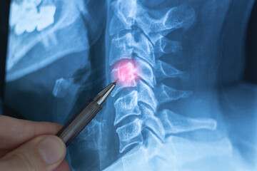 Doctor examining X-ray with cervical lordosis. P-signs of osteochondrosis of the cervical spine. Spondylosis, spondyloarthrosis.