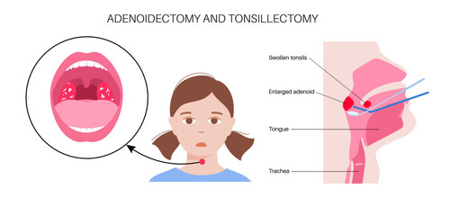 Adenoidectomy medical procedure