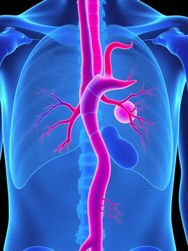 left aorta root bulge of Turner Marfan Syndrome chest disorder heart attack stroke graft for aortic arch pain with hernia high blood vessel clots and stent dilated open renal vein kidney damage