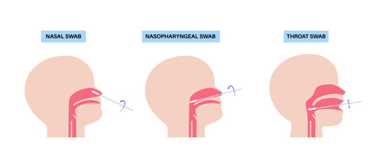 swab medical procedure