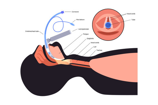 Intubation medical procedure