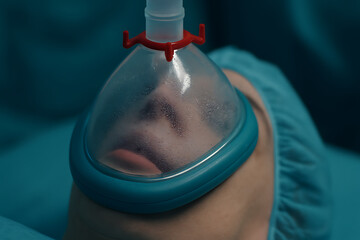 Close-up of a patient wearing an anesthesia mask in a surgical setting.