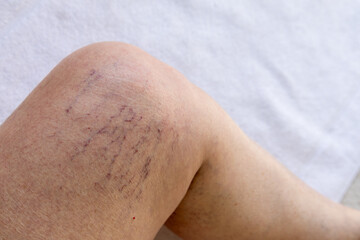 Fototapeta premium Close-up of elderly knee with visible varicose veins