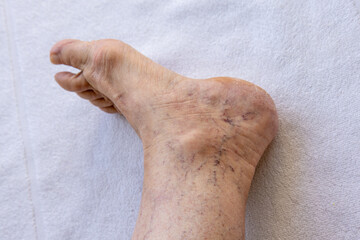 Close-up of elderly foot with visible spider veins