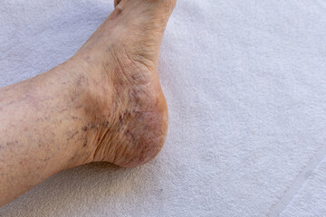 Close-up of elderly foot with visible spider veins