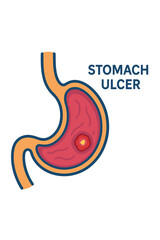 Fototapeta premium Stomach ulcer anatomy illustration with labeled parts and colors stomach ulcer diagram