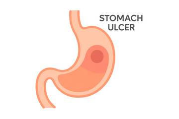 Obraz premium Stomach ulcer illustration showing a detailed diagram of the organ stomach ulcer diagram