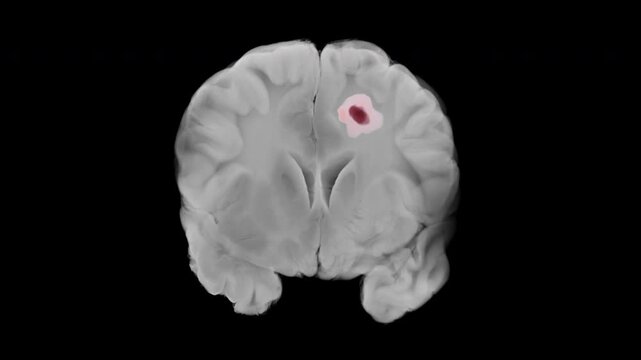Medical animation showing coronal views of the human brain progressing from healthy tissue to advanced glioblastoma in the left cerebral hemisphere, visualized with tumor growth over time.