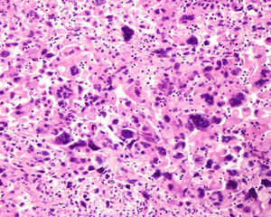 Human lung. Anaplastic epidermoid carcinoma