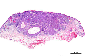 Human tight skin. Adenoid basal cell carcinoma
